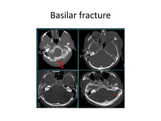 Basilar fracture
 