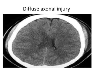 Diffuse axonal injury
 