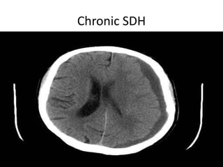Chronic SDH
 