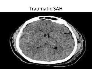 Traumatic SAH
 