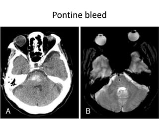 Pontine bleed
 