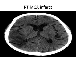 RT MCA infarct
 