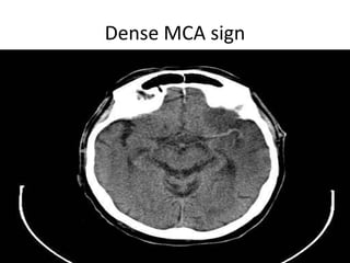 Dense MCA sign
 