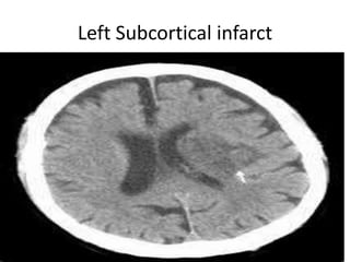 Left Subcortical infarct
 