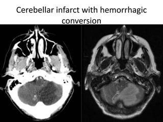 Cerebellar infarct with hemorrhagic
conversion
 