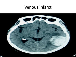 Venous infarct
 