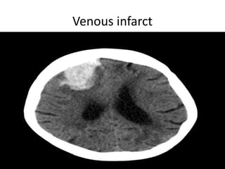 Venous infarct
 