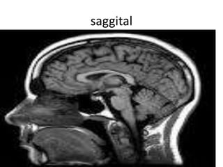 saggital
 