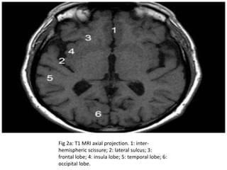 Fig 2a: T1 MRI axial projection. 1: inter-
hemispheric scissure; 2: lateral sulcus; 3:
frontal lobe; 4: insula lobe; 5: temporal lobe; 6:
occipital lobe.
 