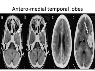 Antero-medial temporal lobes
 