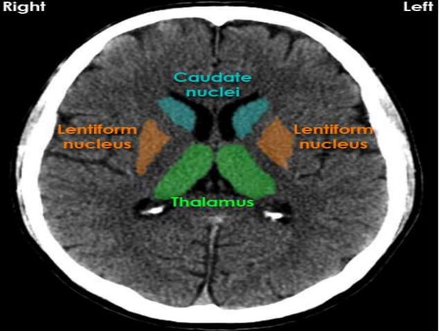 Ct brain presentation | PPT