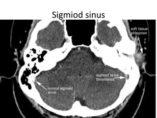 Sigmiod sinus
 
