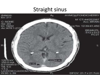 Straight sinus
 