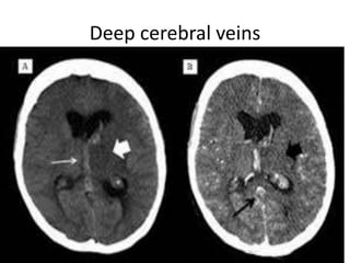 Deep cerebral veins
 