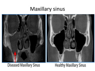 Maxillary sinus
 