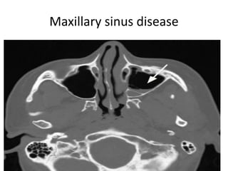 Maxillary sinus disease
 