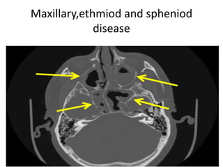 Maxillary,ethmiod and spheniod
disease
 