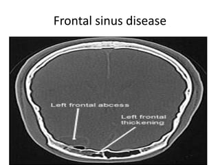 Frontal sinus disease
 