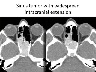 Sinus tumor with widespread
intracranial extension
 
