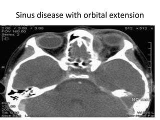 Sinus disease with orbital extension
 