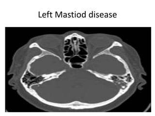 Left Mastiod disease
 