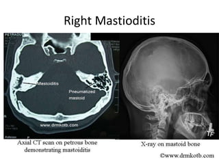 Right Mastioditis
 