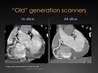 State-of-the-art Cardiac CT of the coronary arteries | PPTX