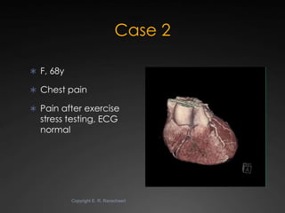 Case 2

 F, 68y

 Chest pain

 Pain after exercise
  stress testing, ECG
  normal




           Copyright E. R. Ransch...