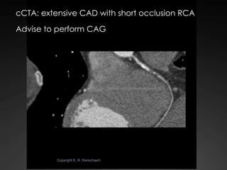 State-of-the-art Cardiac CT of the coronary arteries Slide 45