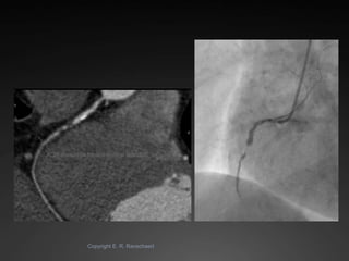 State-of-the-art Cardiac CT of the coronary arteries Slide 47