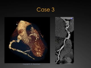State-of-the-art Cardiac CT of the coronary arteries Slide 61