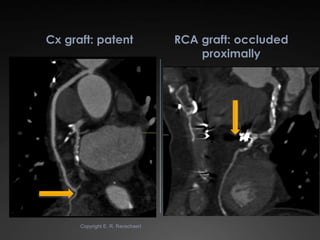 Cx graft: patent                   RCA graft: occluded
                                       proximally




      Copyrig...