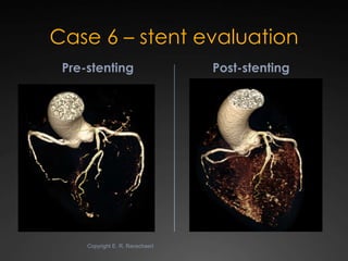 State-of-the-art Cardiac CT of the coronary arteries Slide 73