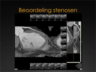 Beoordeling stenosen 