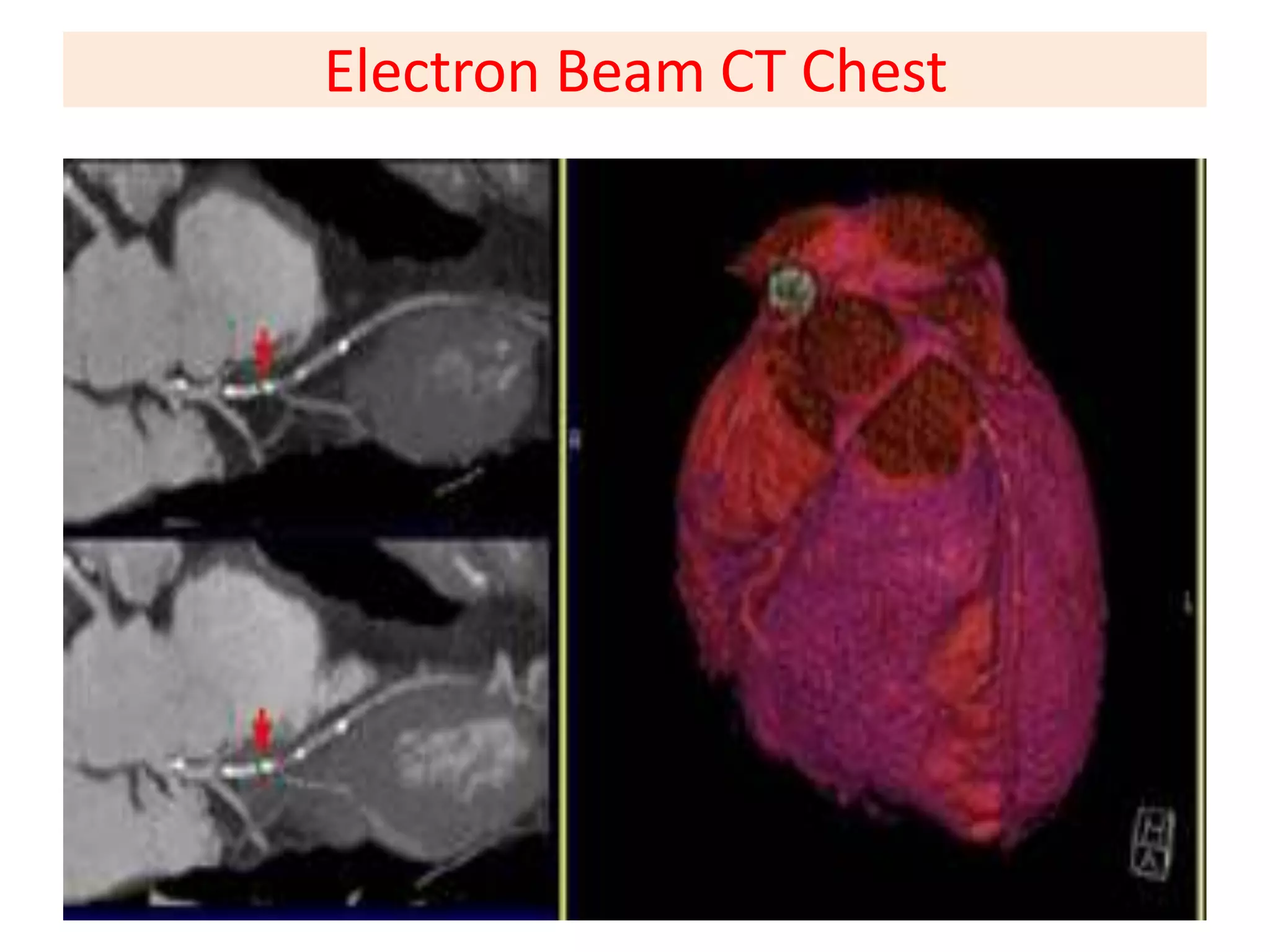 Basics of CT chest | PPTX