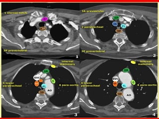 Ct chest fundamentals | PDF