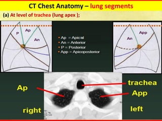 Computed tomography Chest Fundamentals update | PDF