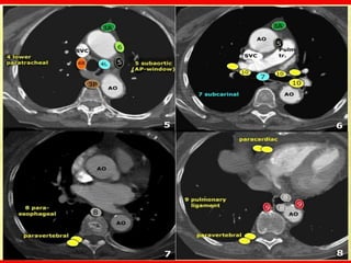 Computed tomography Chest Fundamentals update | PDF