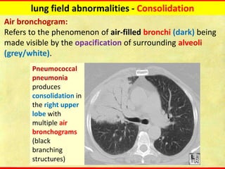 Computed tomography Chest Fundamentals update | PDF
