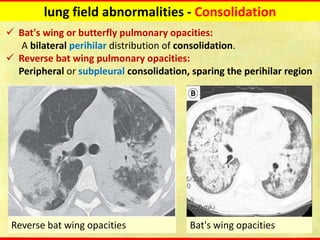 Computed tomography Chest Fundamentals update | PDF
