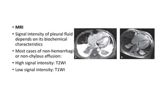 • MRI
• Signal intensity of pleural fluid
depends on its biochemical
characteristics
• Most cases of non-hemorrhagic
or non-chylous effusion:
• High signal intensity: T2WI
• Low signal intensity: T1WI
 