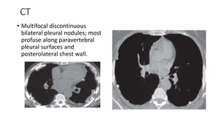 CT
• Multifocal discontinuous
bilateral pleural nodules; most
profuse along paravertebral
pleural surfaces and
posterolateral chest wall.
 