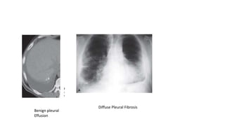 Benign pleural
Effusion
Diffuse Pleural Fibrosis
 