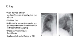X Ray
• Well-defined lobular
nodules/masses; typically abut the
pleura
• Variable size;
• Exhibits the incomplete border sign
(discrepant border visualization on
orthogonal radiographs)
• More common in lower
hemithorax
• Ipsilateral pleural effusion in 20%
 