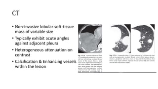 CT
• Non-invasive lobular soft-tissue
mass of variable size
• Typically exhibit acute angles
against adjacent pleura
• Heterogeneous attenuation on
contrast
• Calcification & Enhancing vessels
within the lesion
 