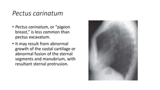 Pectus carinatum
• Pectus carinatum, or “pigeon
breast,” is less common than
pectus excavatum.
• It may result from abnormal
growth of the costal cartilage or
abnormal fusion of the sternal
segments and manubrium, with
resultant sternal protrusion.
 