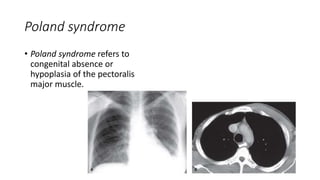 Poland syndrome
• Poland syndrome refers to
congenital absence or
hypoplasia of the pectoralis
major muscle.
 