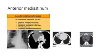 Anterior mediastinum
 