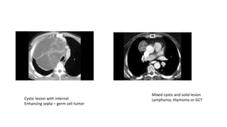 Cystic lesion with internal
Enhancing septa – germ cell tumor
Mixed cystic and solid lesion
Lymphoma, thymoma or GCT
 
