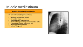 Middle mediastinum
 